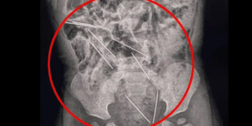 Bebé de 2 años se traga agujas para inyectar vacas y logra sobrevivir en Perú