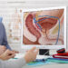 Uno de Cada 6 Hombres Será Diagnosticado con Cáncer de Próstata: Expertos