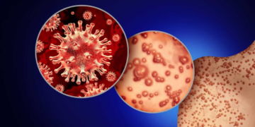 Se confirma el primer caso de viruela del mono en Sinaloa