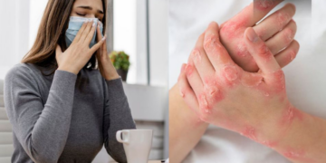 Virus mpox vs. COVID-19: ¿Qué enfermedad es más peligrosa y por qué?