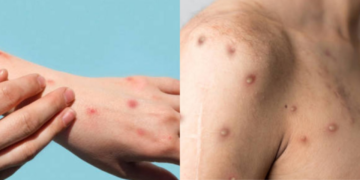 ¿Cuáles son los síntomas de mpox y qué diferencia hay entre las cepas de Mpox?