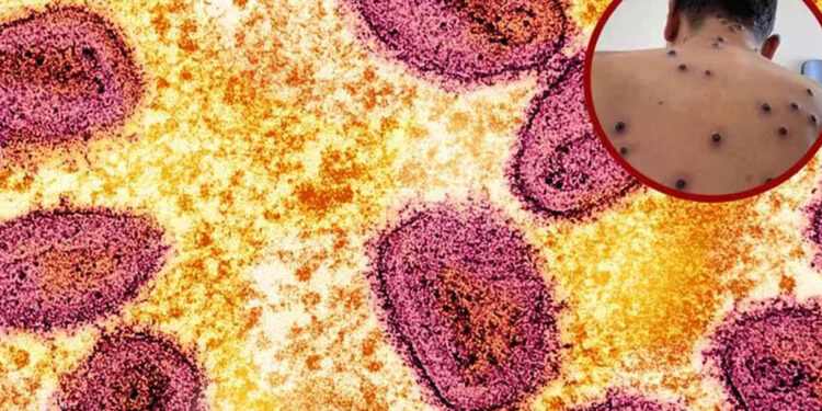 Viruela del mono: Estos estados han reportado casos en México