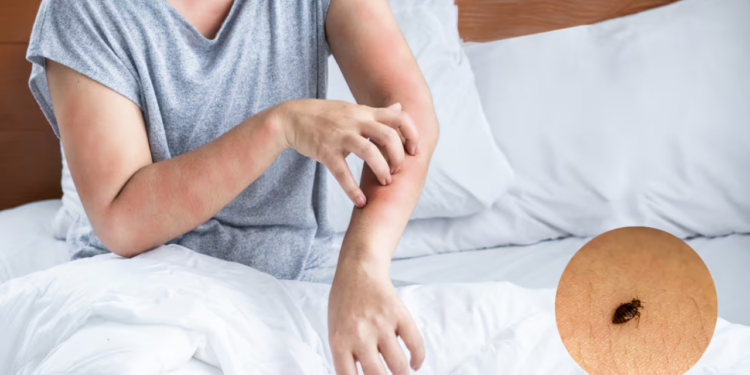 ¿Cómo aliviar la picazón por picaduras de chinches: 3 soluciones rápidas y efectivas?