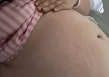 Creía estar embarazada, pero tiene un raro estreñimiento que le hizo sacar las entrañas
