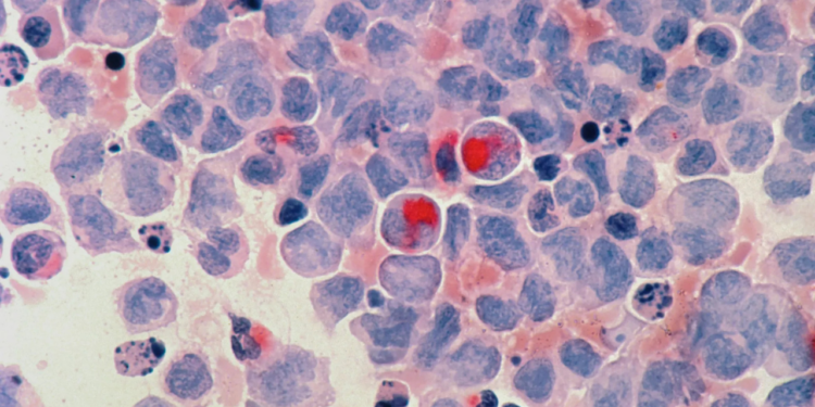 Huellas moleculares pueden mejorar detección precoz del cáncer