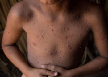 Virus coxsackie cambia, hay ALERTA por casos fuera de temporada y en niños más grandes