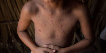 Virus coxsackie cambia, hay ALERTA por casos fuera de temporada y en niños más grandes