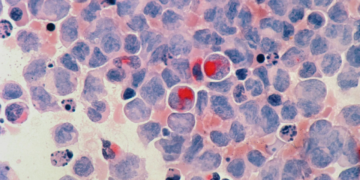 Día Mundial contra el Cáncer, generar conciencia sobre la prevención y control de este padecimiento