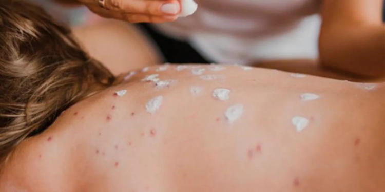 Mayor brote de sarampión en EE.UU. acecha a México