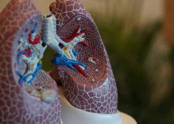 Neumonía bilateral: Una afección respiratoria seria