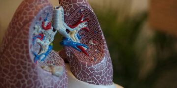 Neumonía bilateral: Una afección respiratoria seria