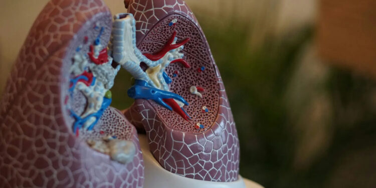 Neumonía bilateral: Una afección respiratoria seria