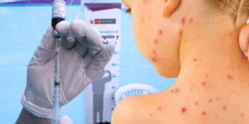 Salud registra 48 muertes de menores de un año por tosferina y 583 casos de sarampión