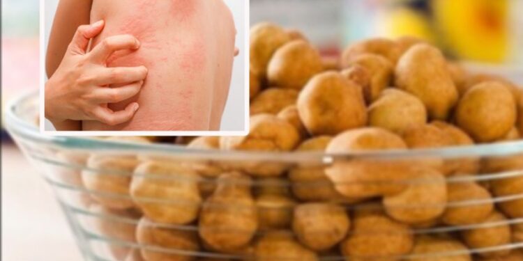Retiran esta famosa marca de CACAHUATES de todas las tiendas, alertan por reacciones alérgicas como urticaria