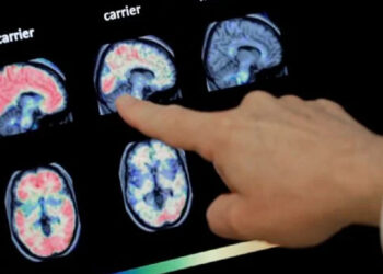 Comenzará la distribución de Donanemab en México, medicamento aprobado para el Alzheimer
