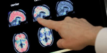 Comenzará la distribución de Donanemab en México, medicamento aprobado para el Alzheimer