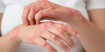 ¿Te salen ronchas cuando sube la temperatura? Descubre qué es la urticaria por calor y cómo evitarla