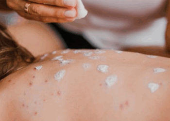 BCS identifica tres casos probables de sarampión en niños